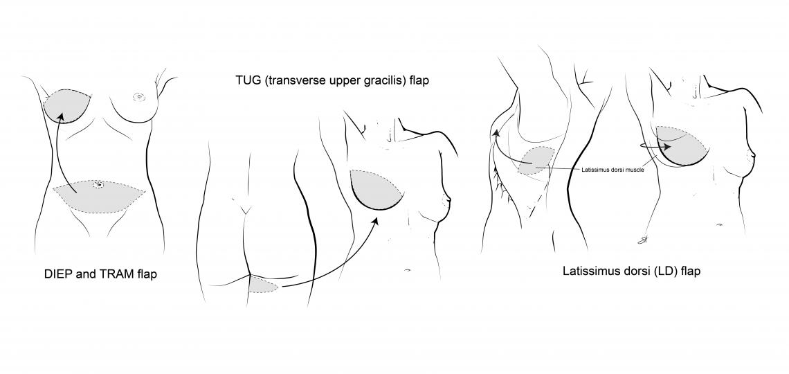 Illustration of thigh and lat flap reconstruction
