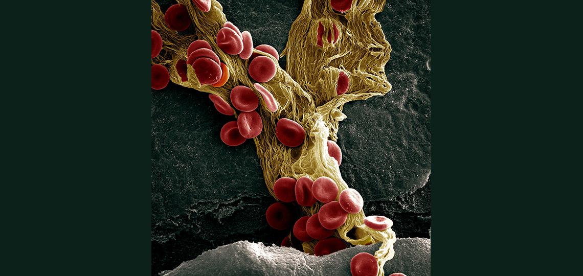 Fibrin Falls: A small bleed frozen in time, captured via scanning electron microscopy.