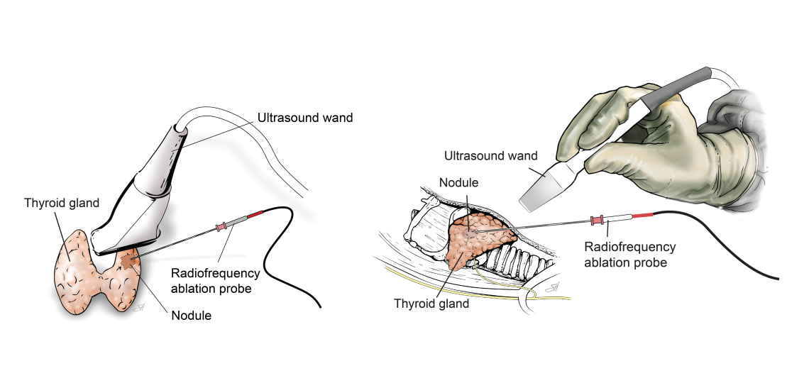 An illustration of the thyroid ablation procedure.