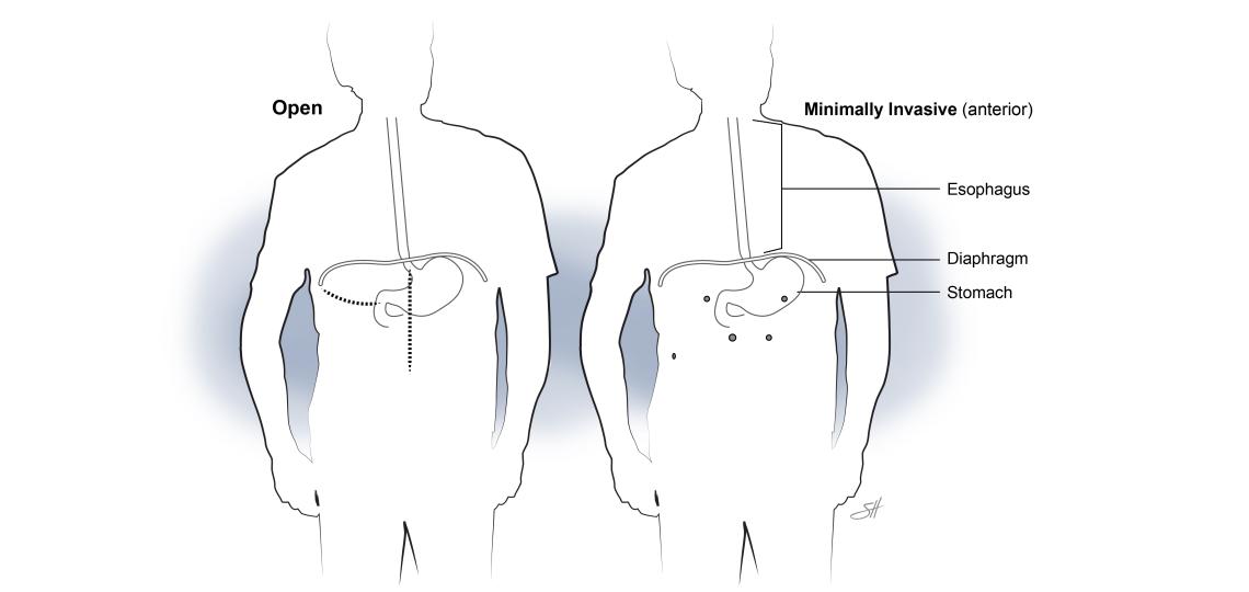 Esophagectomy Baylor Medicine   Incision Sites Open Vs Robotic Esophagectomy By Scott Holmes 