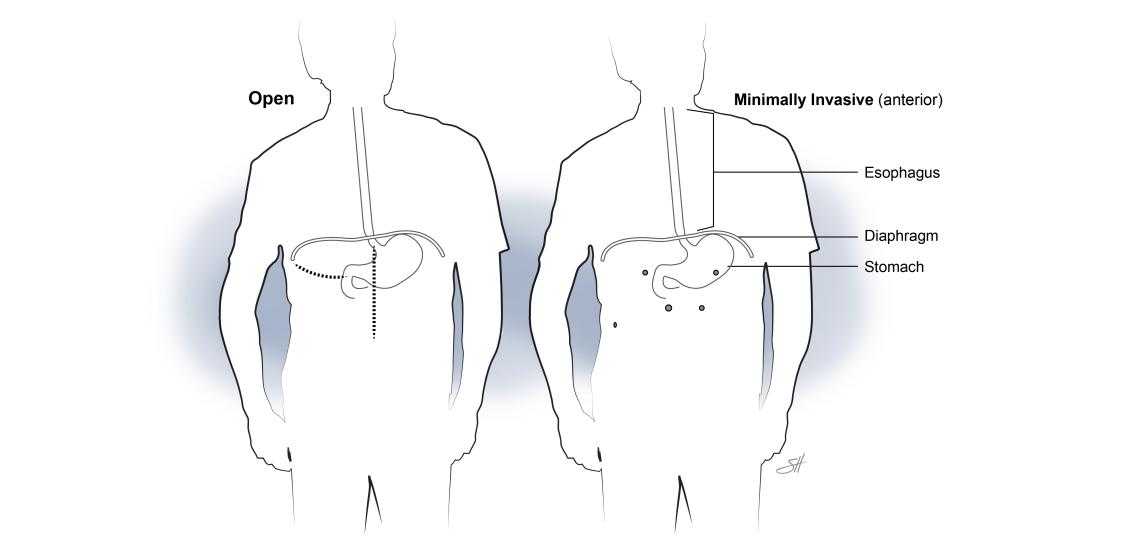 Illustration of incision sites of an esophagectomy