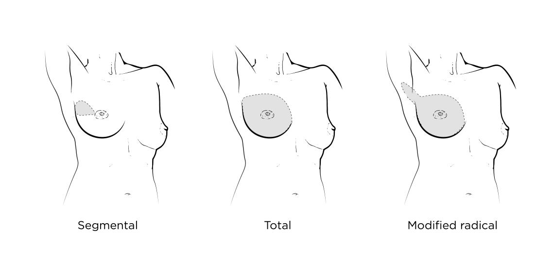 Illustration of the different types of mastectomies. Segmental, total, and modified radical.