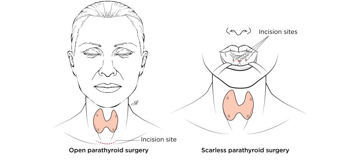 Illustration of open vs Scarless parathyroid surgery