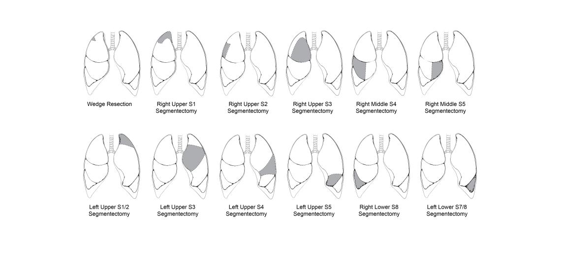Diagram of lung resection areas.