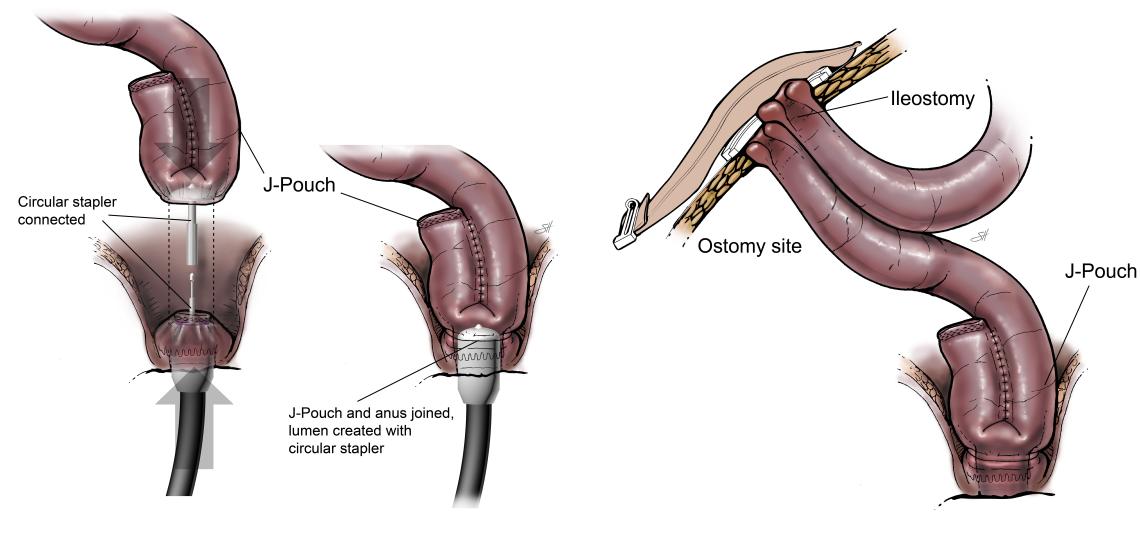 Proctectomy with j pouch.