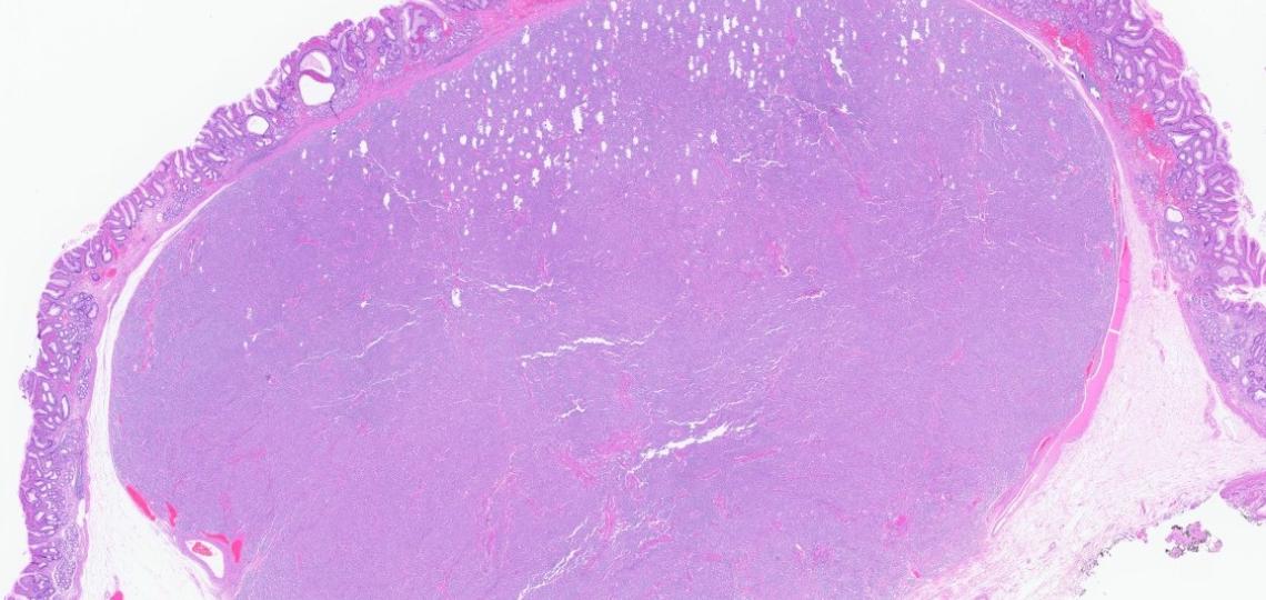 Histology of a neuroendocrine tumor