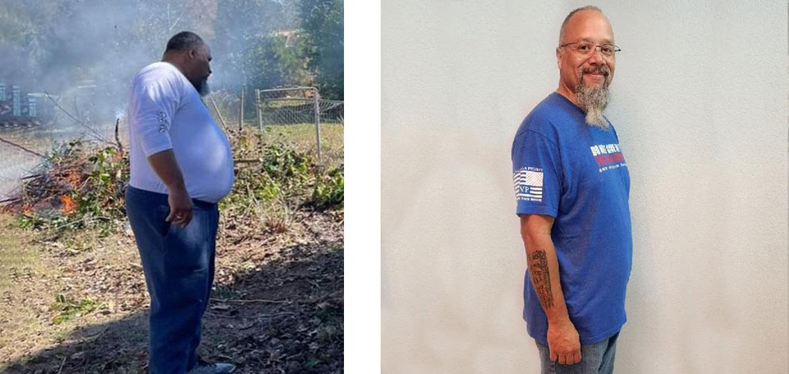 Bariatric patient Orlando, before and after.