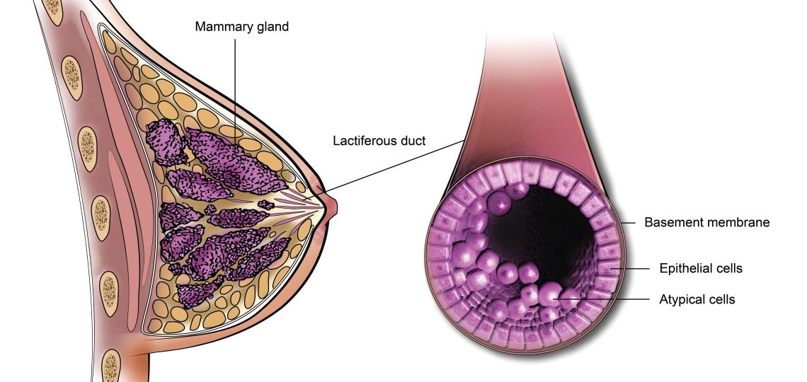 DCIS mammary gland
