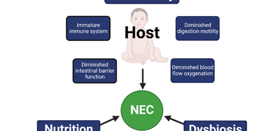 Illustration of the “NEC triad” of the major risk factors for NEC including prematurity, gut dysbiosis and nutrition