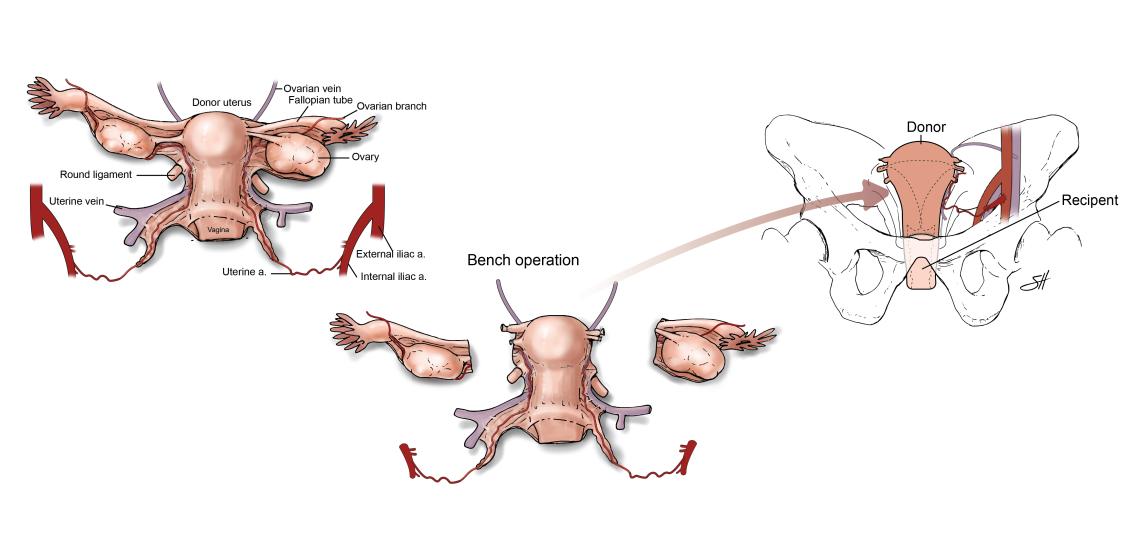 The three steps of uterine transplant.