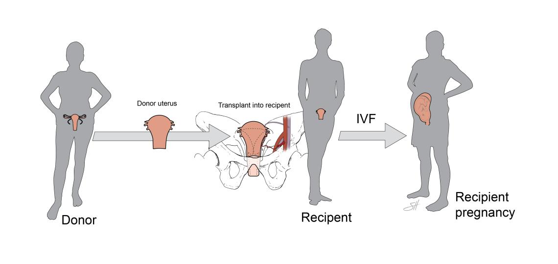 Uterine transplant process. 