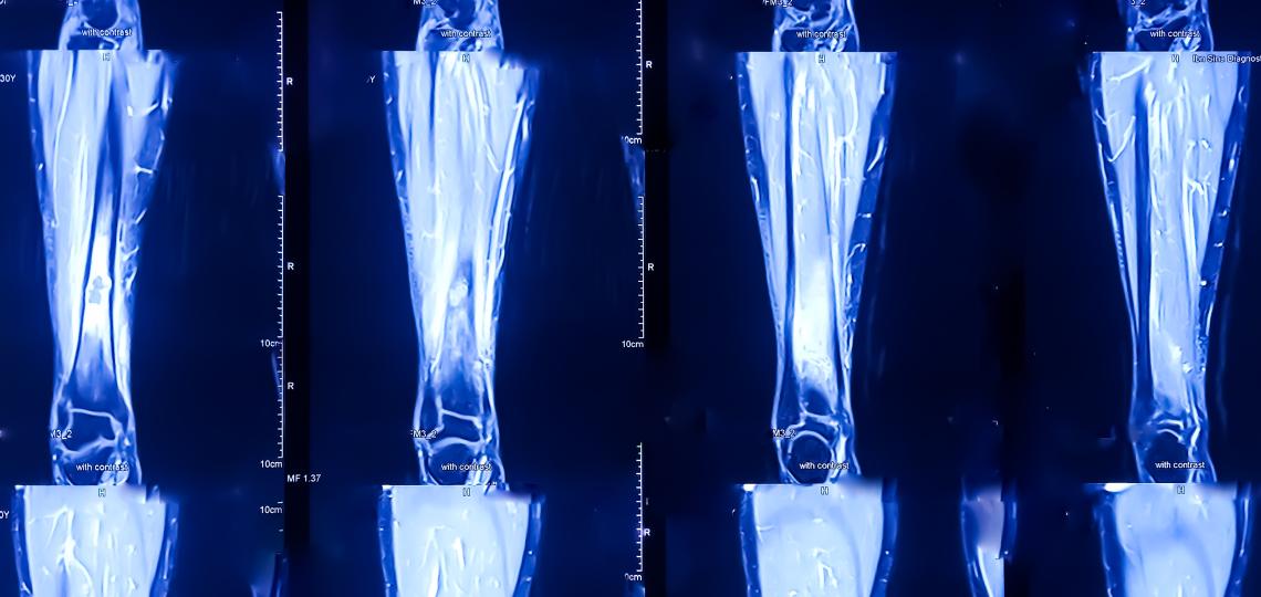 x-ray of a fractured leg