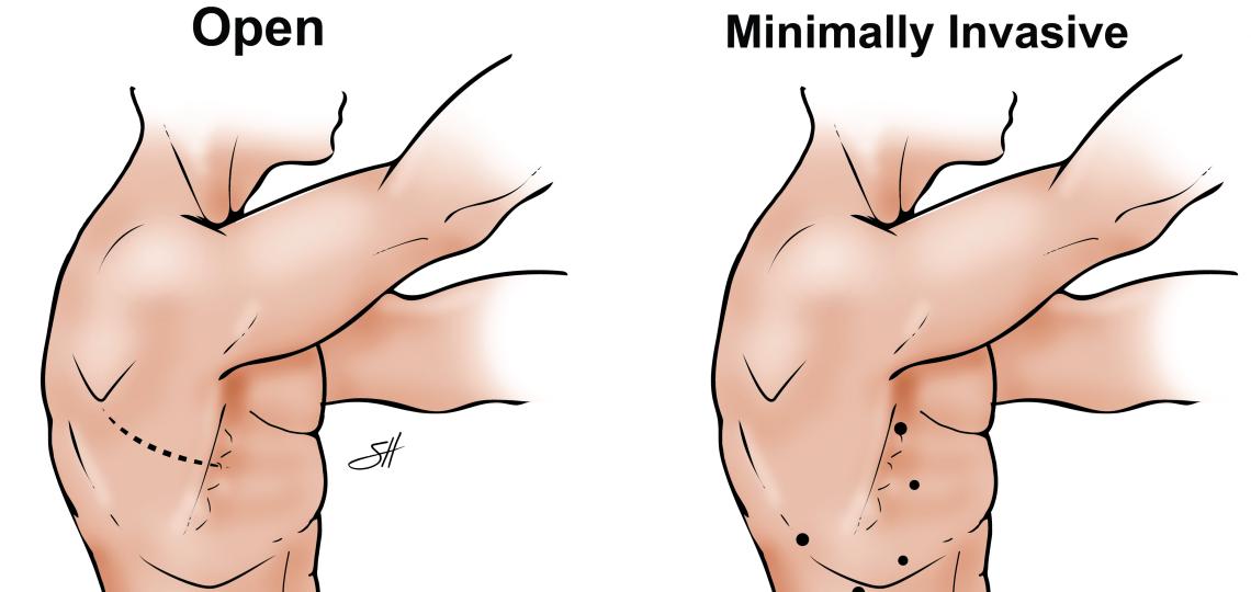 Illustration depicting the entry points for open and minimally invasive lung resection procedures.
