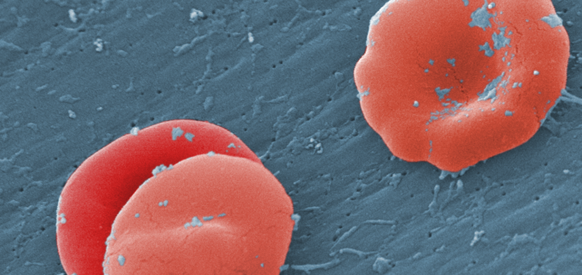 Under a high magnification of 8000X, this scanning electron micrograph (SEM) revealed some of the ultrastructural morphology displayed by red blood cells (RBCs) in a blood specimen of a 6 year old male patient that has sickle cell with hereditary persiste