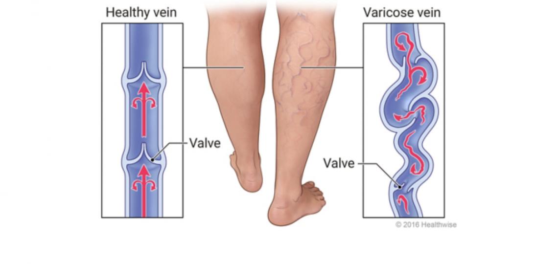 Premier Vein & Vascular - Tampa, FL & Largo, FL - Types of Varicose Veins