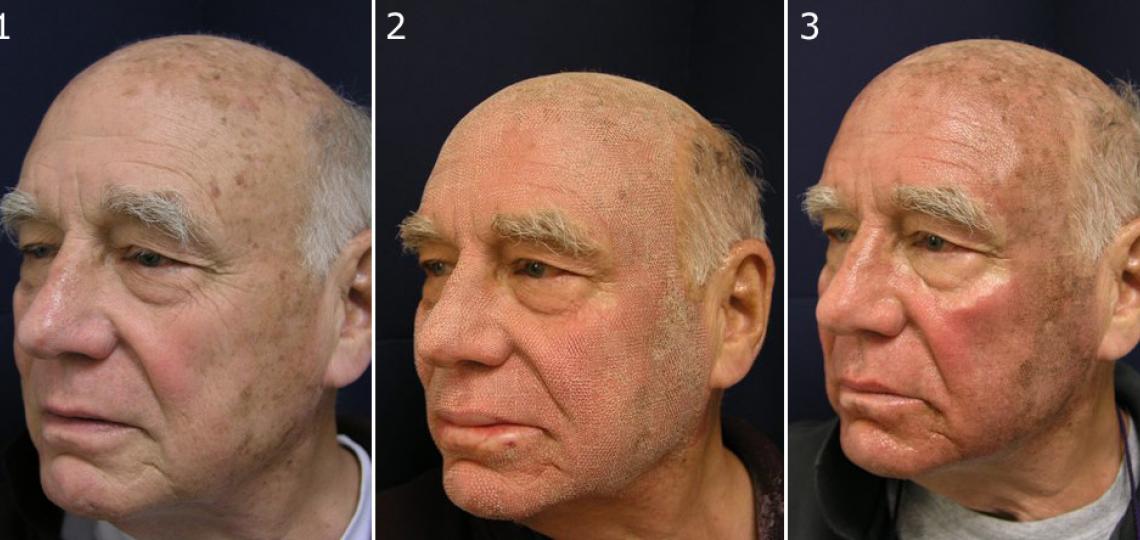 (1) Before Active FX laser treatment. (2) Immediately after treatment. (3) Four days after treatment.