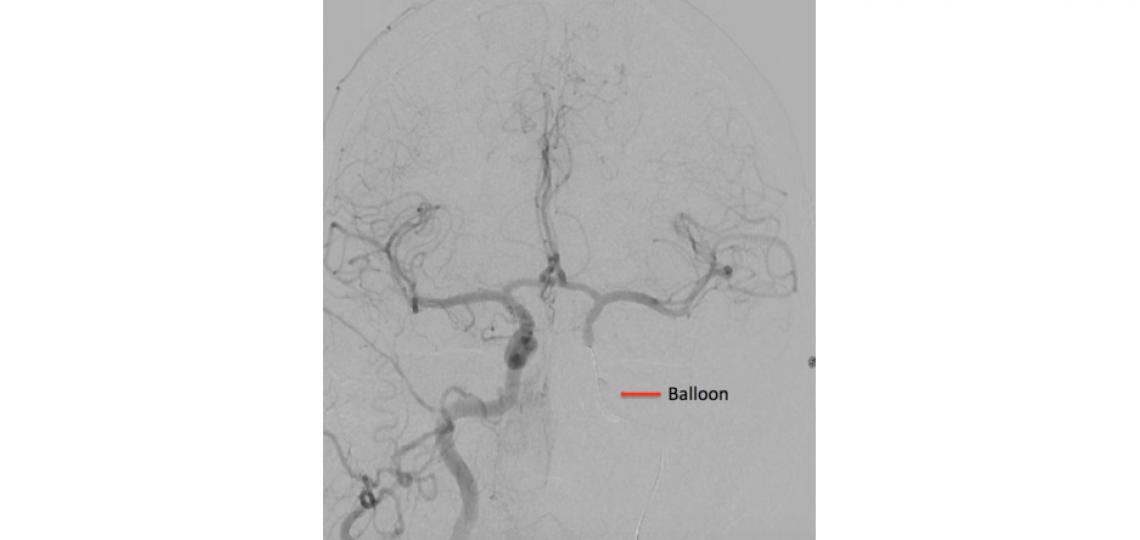 A right internal carotid artery injection with a balloon inflated in the left internal carotid artery (arrow) shows good collateral filling to the left hemisphere during a test occlusion of the left internal carotid artery.