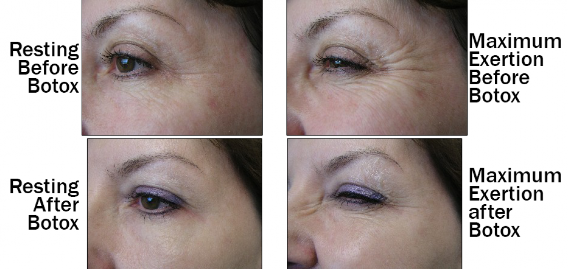 How Does Botox® Prevent Wrinkles?