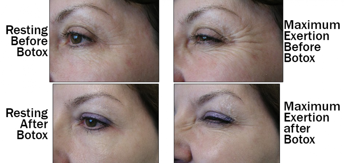 Before and After, Botox for wrinkles.