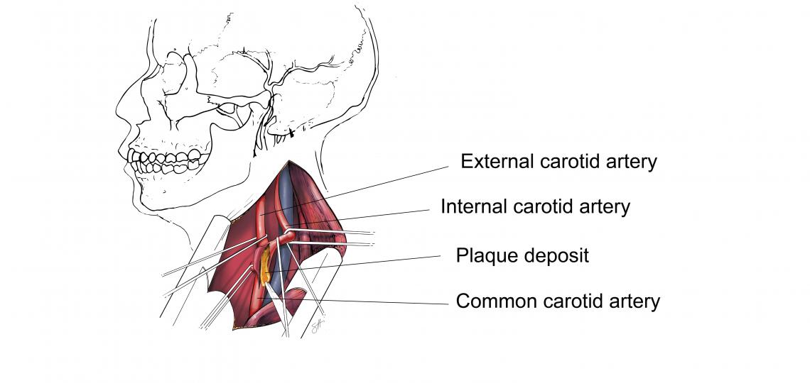 Carotid endarterectomy