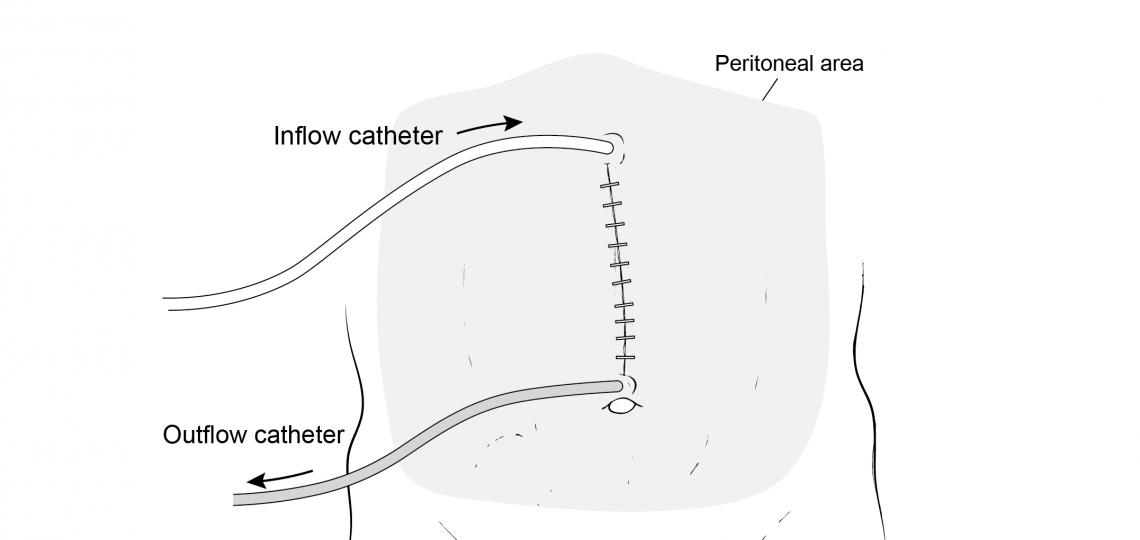 Hyperthermic Intraperitoneal Chemoperfusion