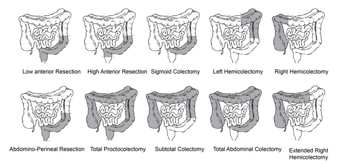 Surgical Procedures In Resection At An Anterior Site Of The Spinal Cord