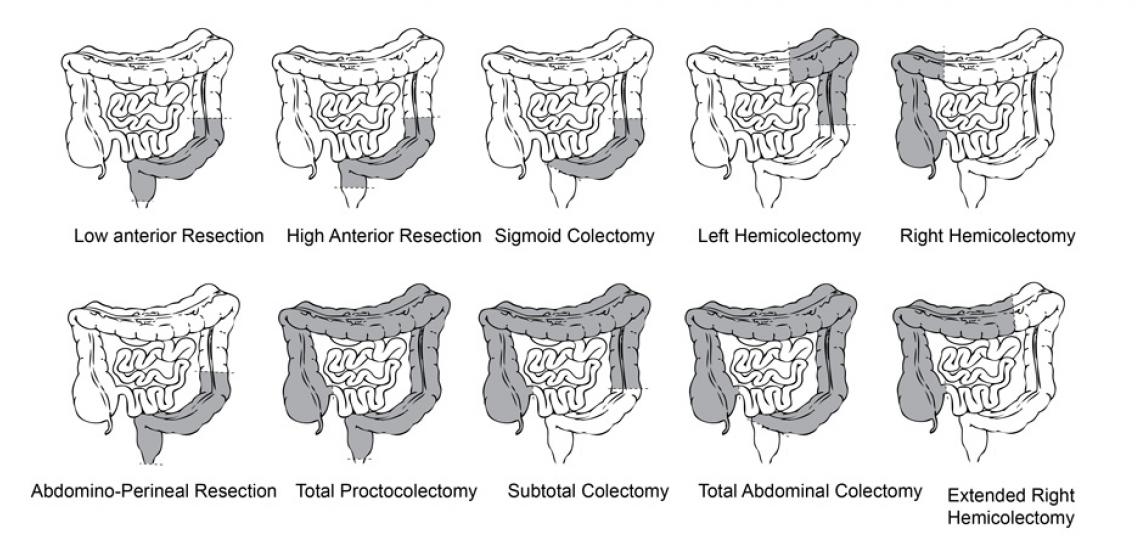 total abdominal colectomy