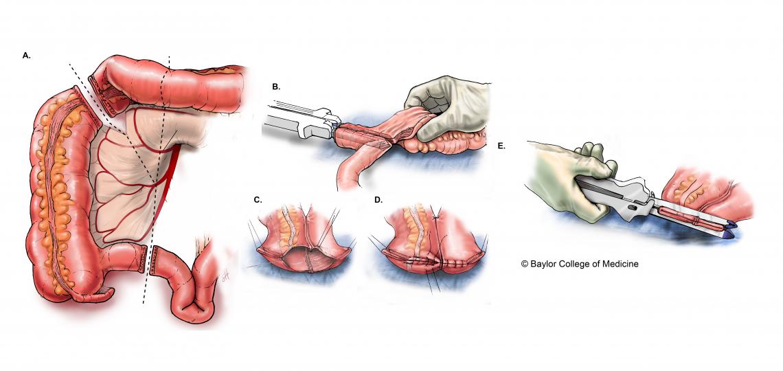 Colon Resection