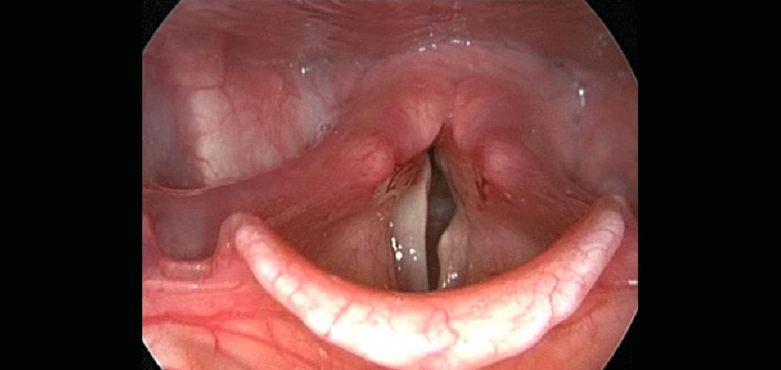 Cordotomy