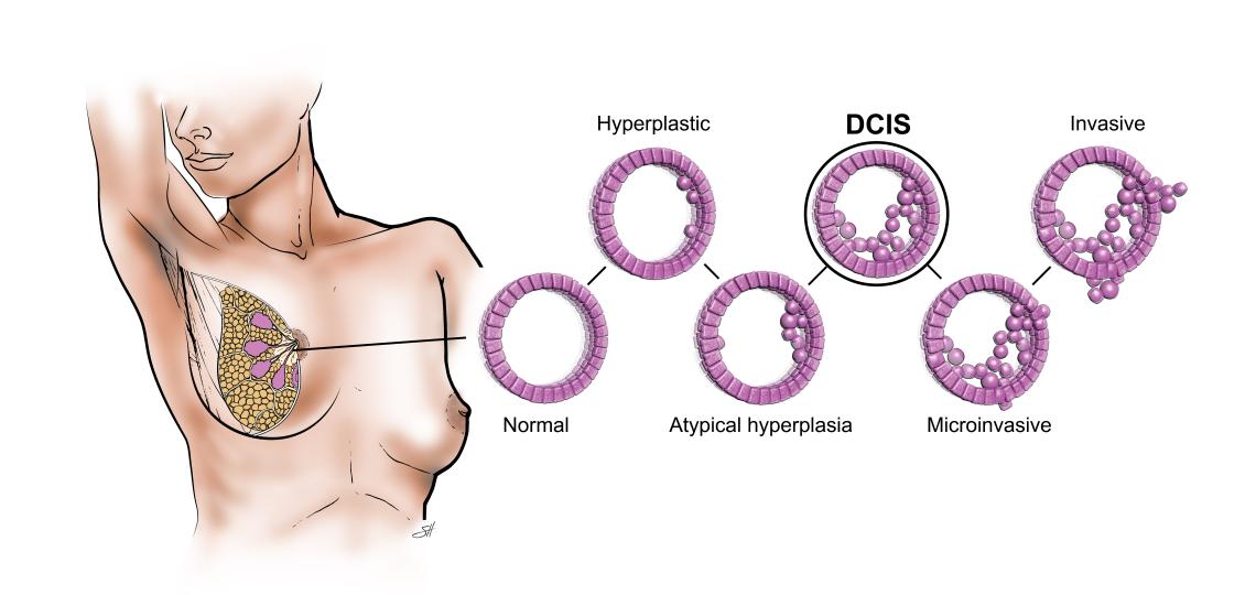 Ductal Carcinoma In Situ (DCIS)