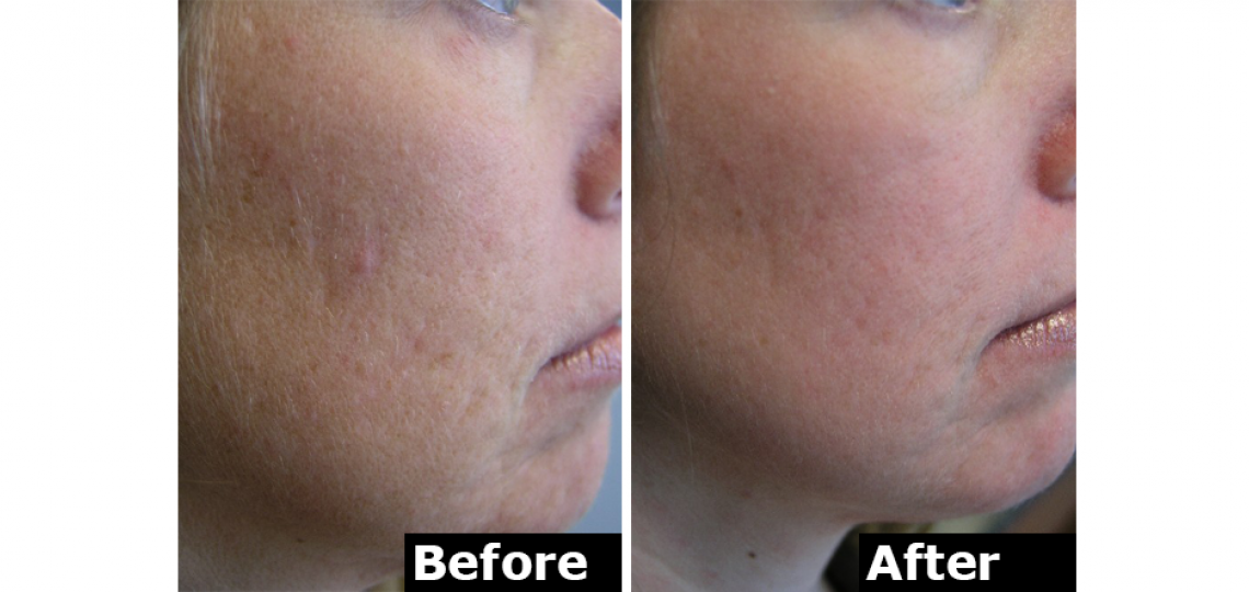 Derm Laser Fraxel