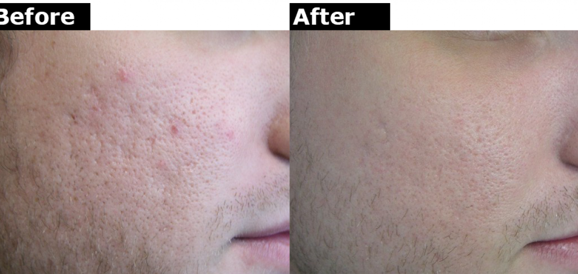 Derm Laser Fraxel