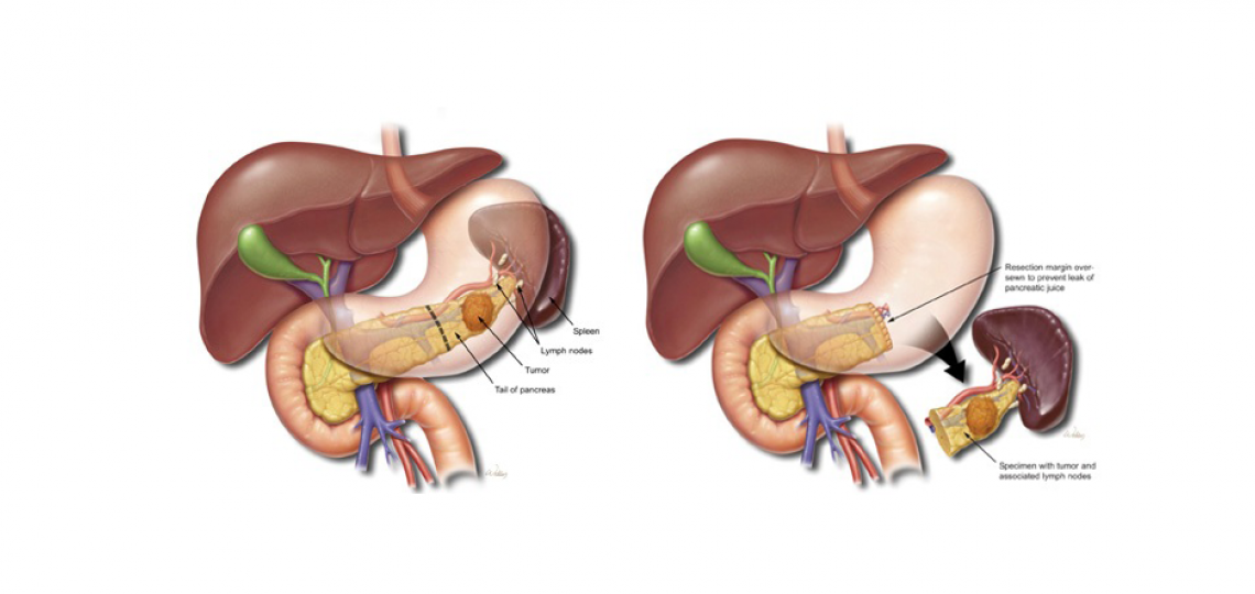 Distal Pancreatectomy and Splenectomy