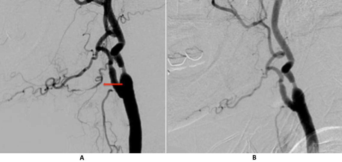 Right common carotid injection (A) shows an irregular lingual artery as the source of bleeding (arrow). The lingual artery no longer fills on the post embolization angiogram (B).