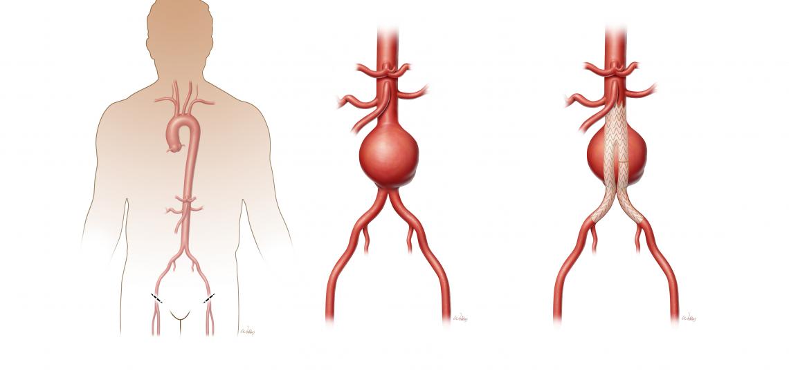 Ascending and Arch Aortic Aneurysms and Dissection BCM