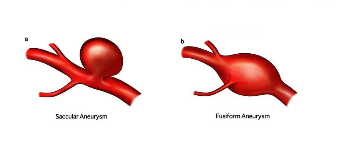Brain aneurysms