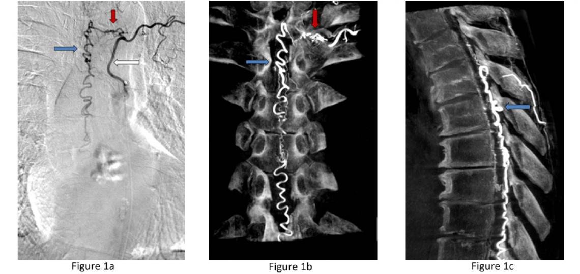 Figure 1. Spinal Vascular Malformations