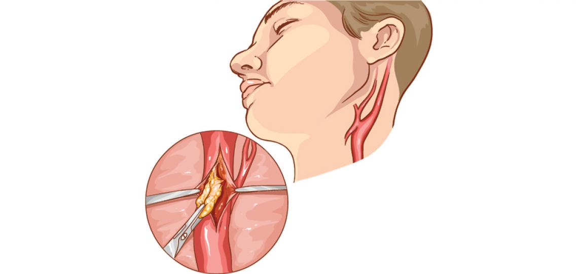 Artist depiction of a carotid endarterectomy surgery at the stage where the atherosclerotic plaque is being removed from the artery
