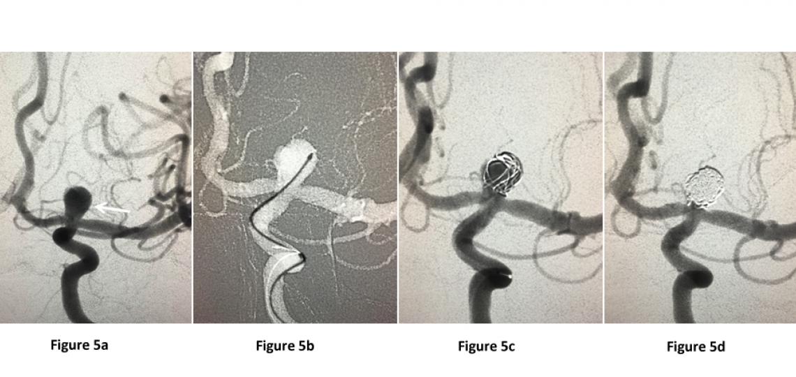 Figure 5. Brain angiogram