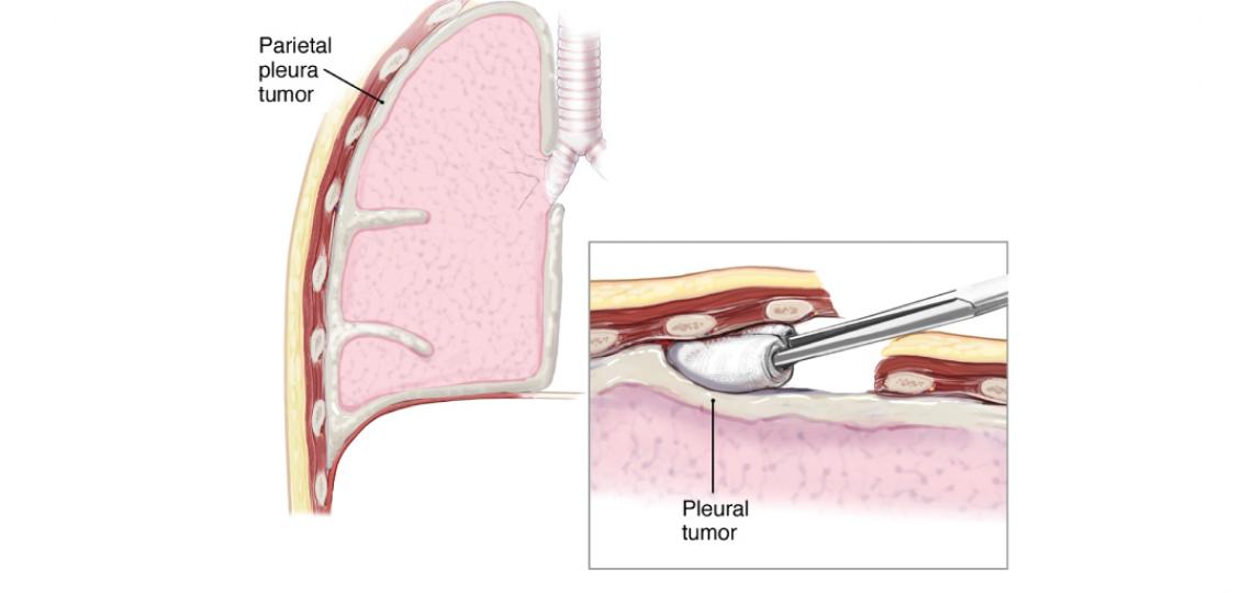 Pleurectomy is begun between the endothoracic fascia and the parietal pleura. Image courtesy McGraw-Hill Company.