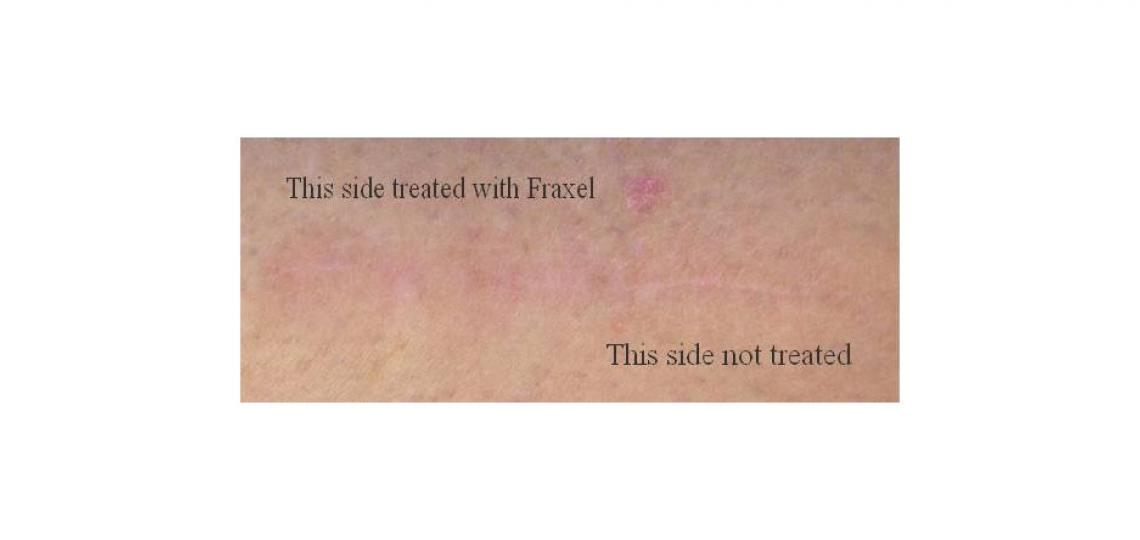 Above is a Baylor Dermatology patient who allowed treatment of one part of her surgical scar with three Fraxel sessions. The treated part of the scar has partially faded into the skin improving the appearance.