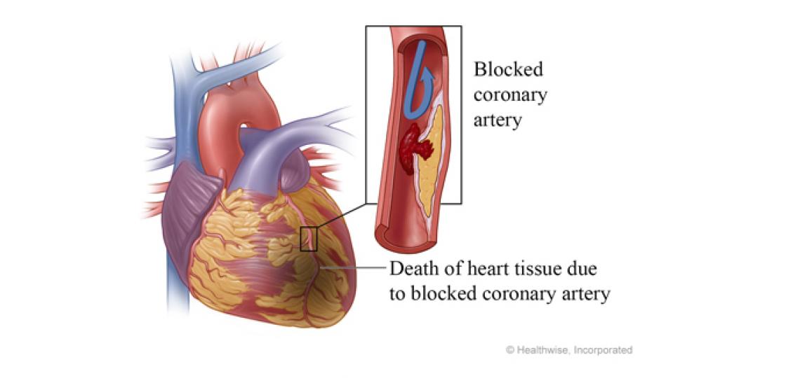 Coronary Artery Bypass