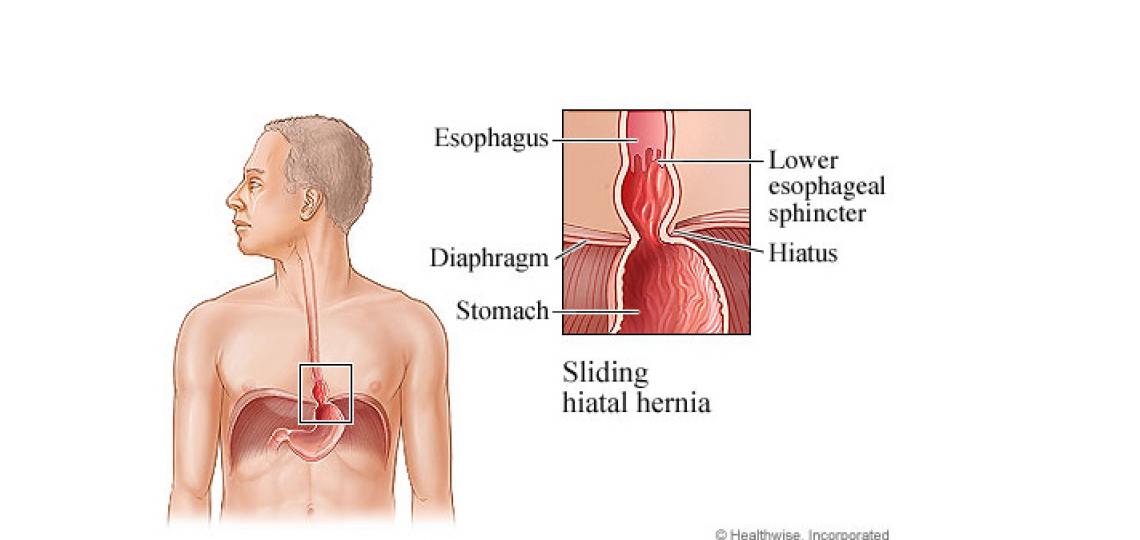 Hiatal Hernia Repair Baylor Medicine