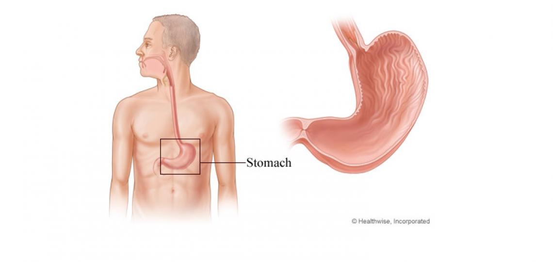 partial gastrectomy