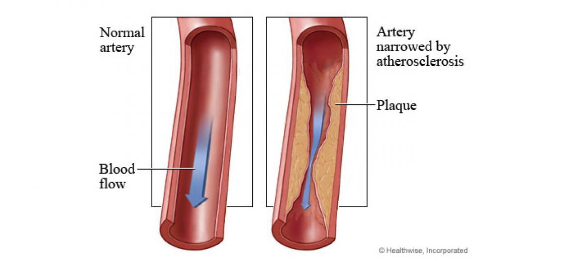 Peripheral Artery Disease Baylor Medicine