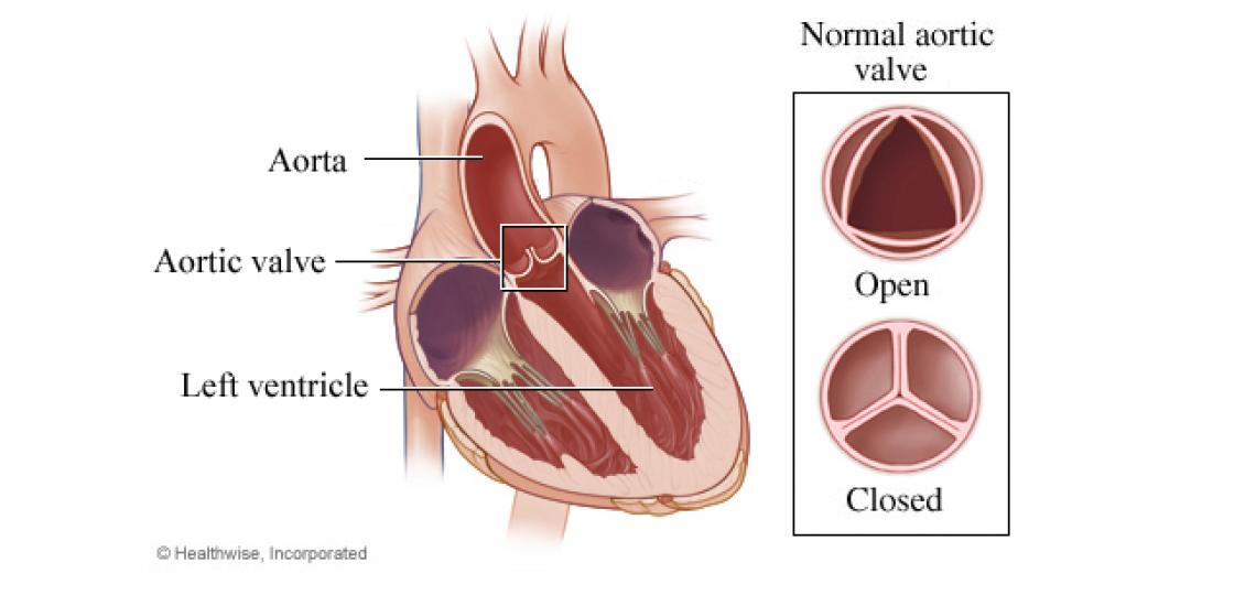 Aortic Valve Repair