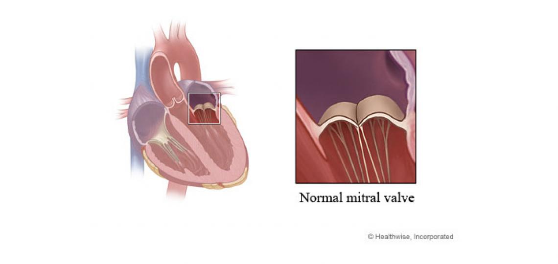 Mitral Valve Prolapse Repair Baylor Medicine