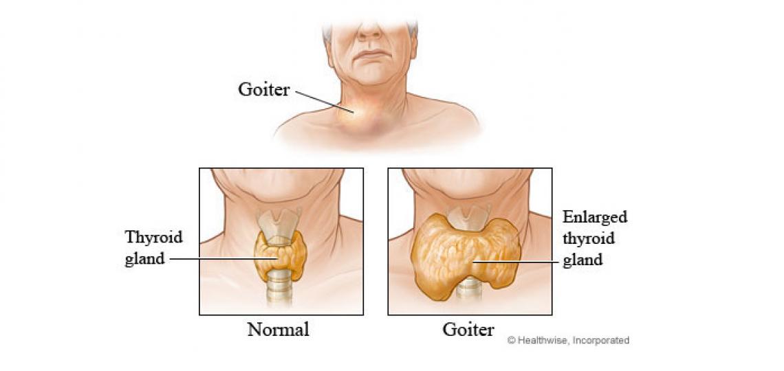 Often goiter can be easily seen as a lump in the front of the neck, slightly to the left and/or right of center.
