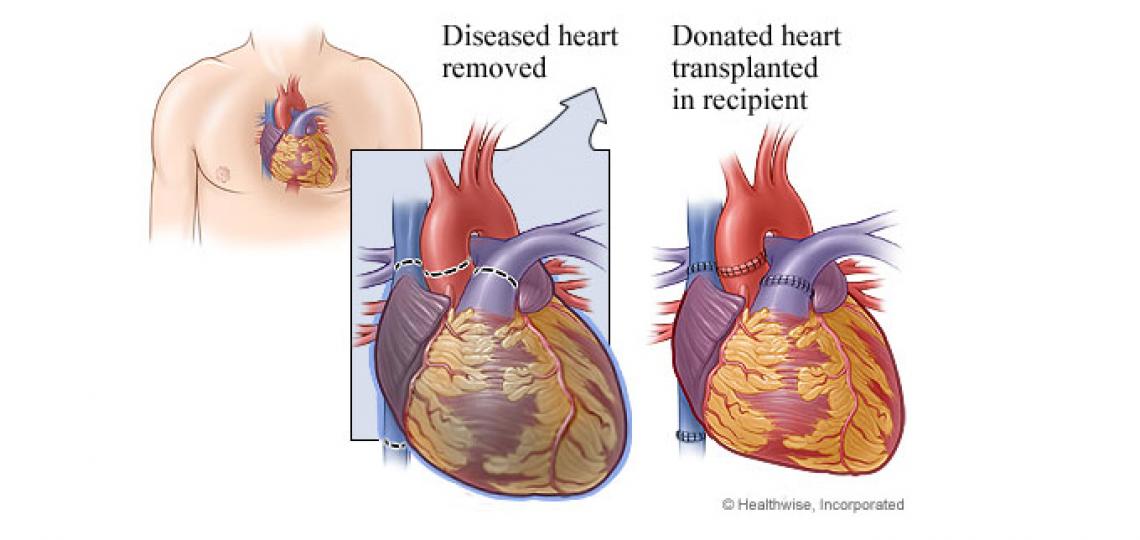 Heart transplant