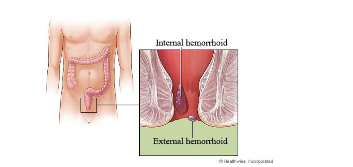 Hemorrhoid